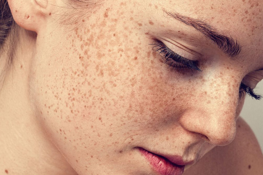Những yếu tố ảnh hưởng đến sự xuất hiện của nám da
